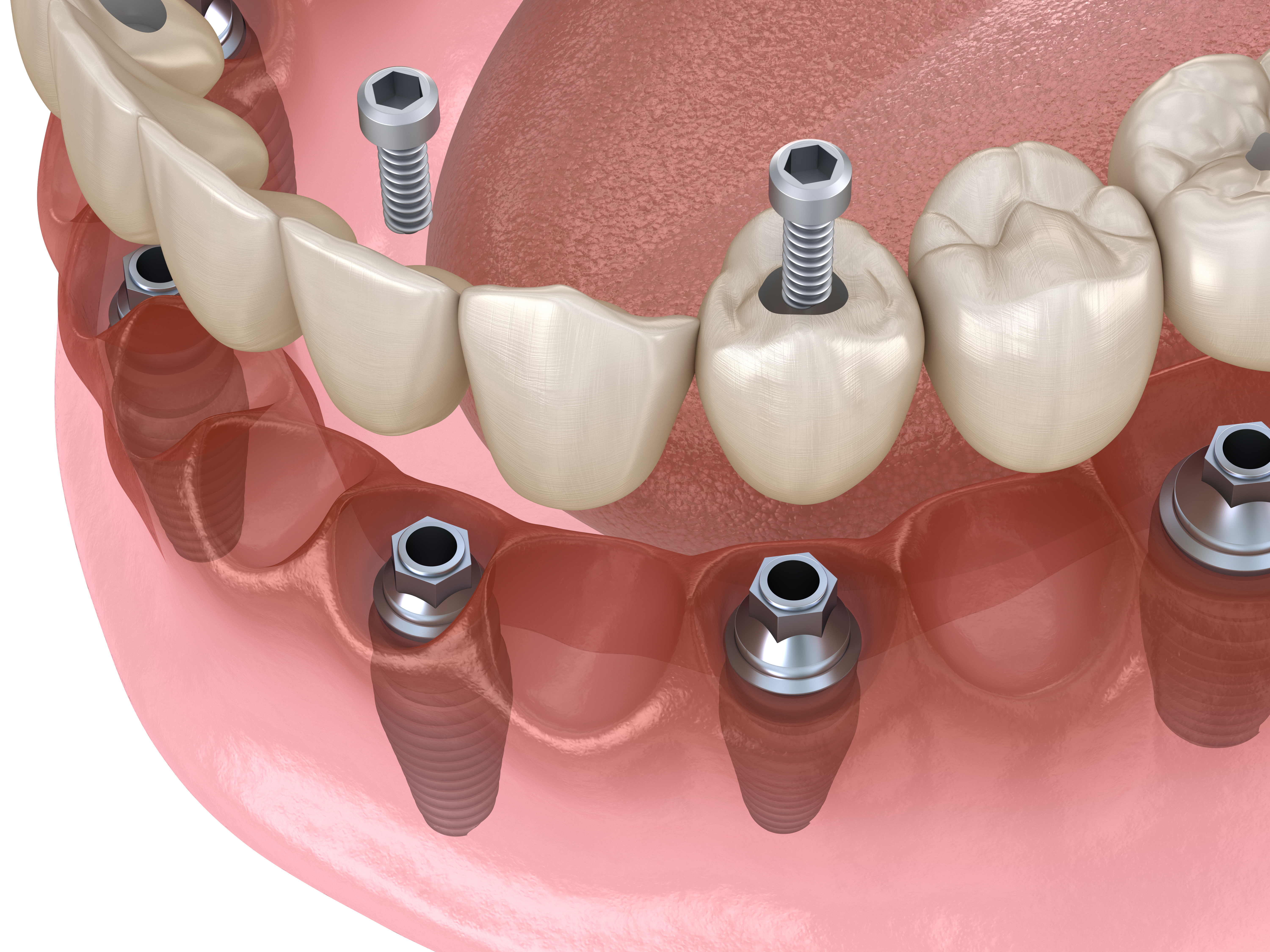 Fixed denture example