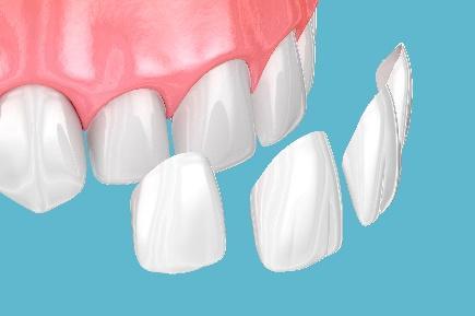 Veneers