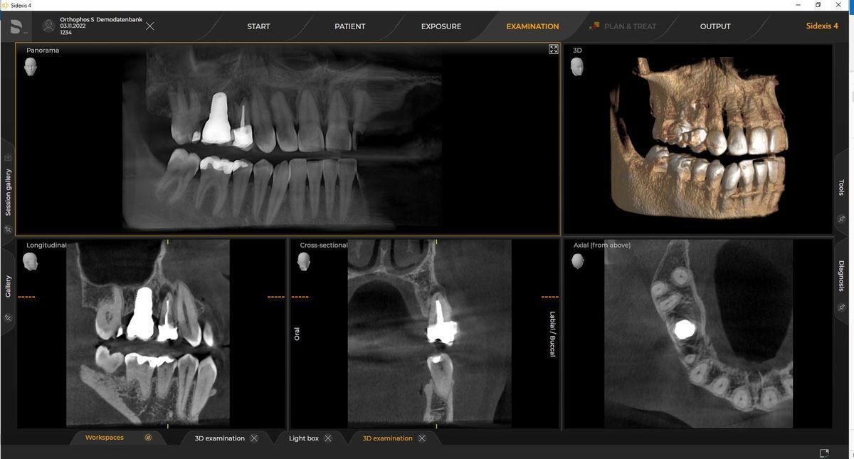 Intraoral scanner in use